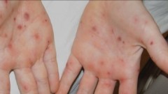 Senegal prijavio prvi slučaj majmunskih boginja ove godine thumb1.jpg